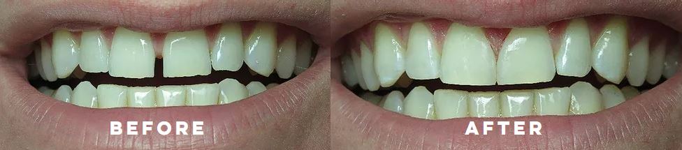 Orthodontics Before After